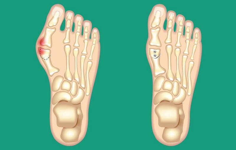 Bunion Relief: The Best Strategies for Small Changes