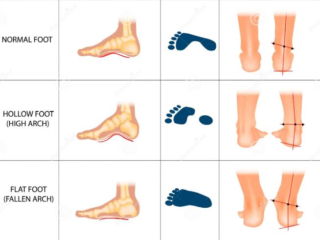 Hollow Feet: A Revolutionary In-Depth Guide for Optimal Foot Health