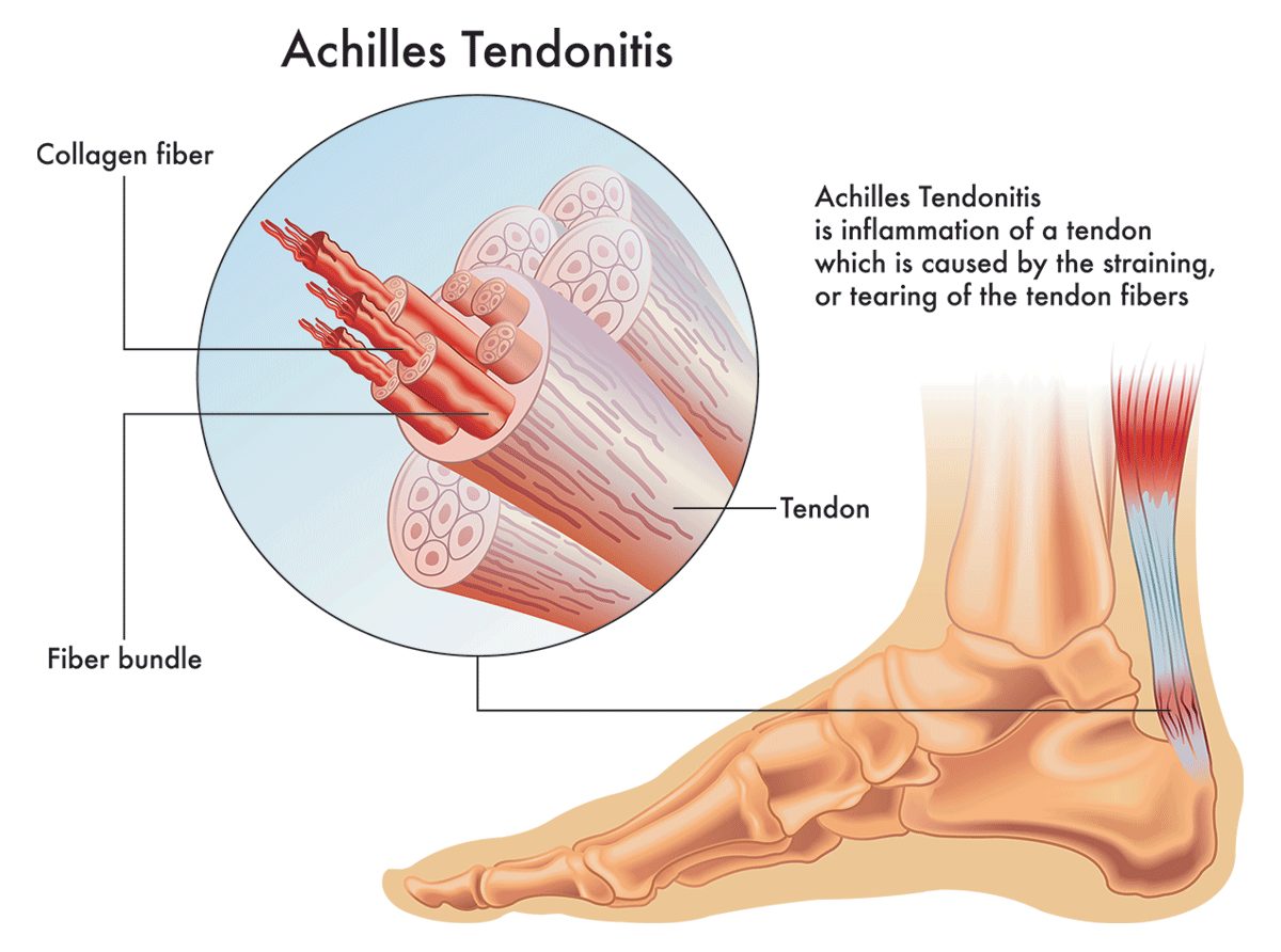 Comprehensive Insights into Achilles Tendonitis: Causes, Symptoms, and Relief Strategies