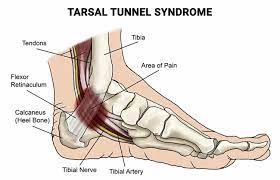 Navigating Tarsal Tunnel Syndrome: A Comprehensive Guide