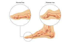 Comprehensive Guide for Hammertoe Relief and Correction