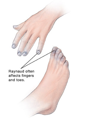 Managing Raynaud's Phenomenon: Strategies for Reducing Impact on the Feet