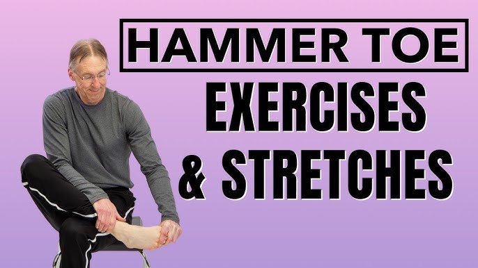 Managing Hammertoe: Exercises and Footwear Recommendations