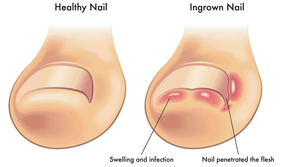 Navigating the Pain of Ingrown Toenails: Causes, Symptoms, and Prevention