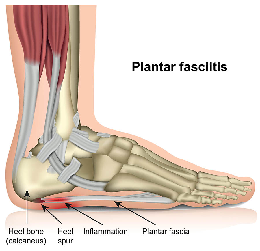 Mastering Plantar Fasciitis Relief: Strategies for Enhanced Comfort and Mobility