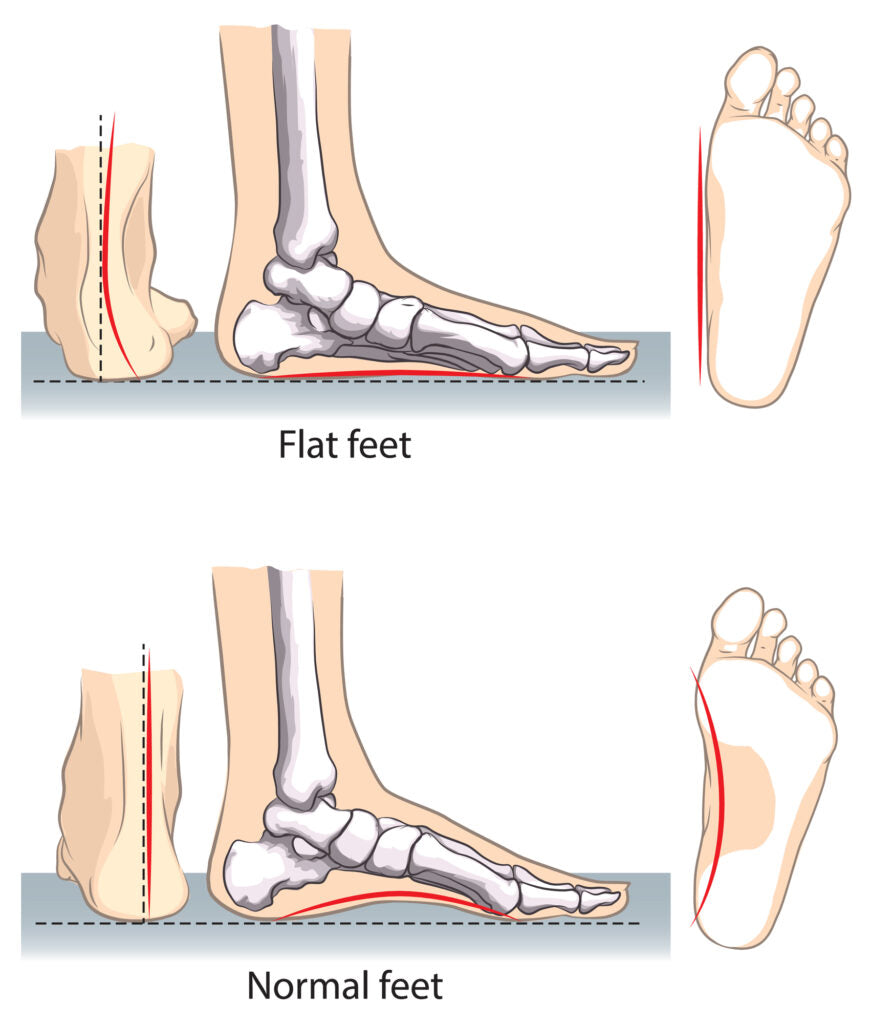 Mastering Flat Feet: Navigating Challenges and Solutions for Improved Daily Living